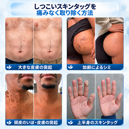 𝐇𝐞𝐚𝐥𝐫𝐢𝐳𝐞® ✨2️⃣ 肌のイボや気になる色素沈着を7日間集中ケア（やさしい処方で痛みなし・跡が残りにくい）🌿